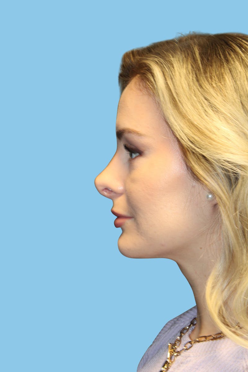 Rhinoplasty Before & After Gallery - Patient 166732 - Image 4