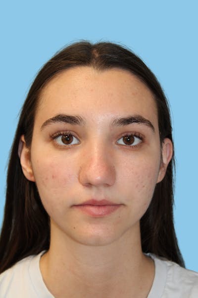 Rhinoplasty Before & After Gallery - Patient 252258 - Image 1