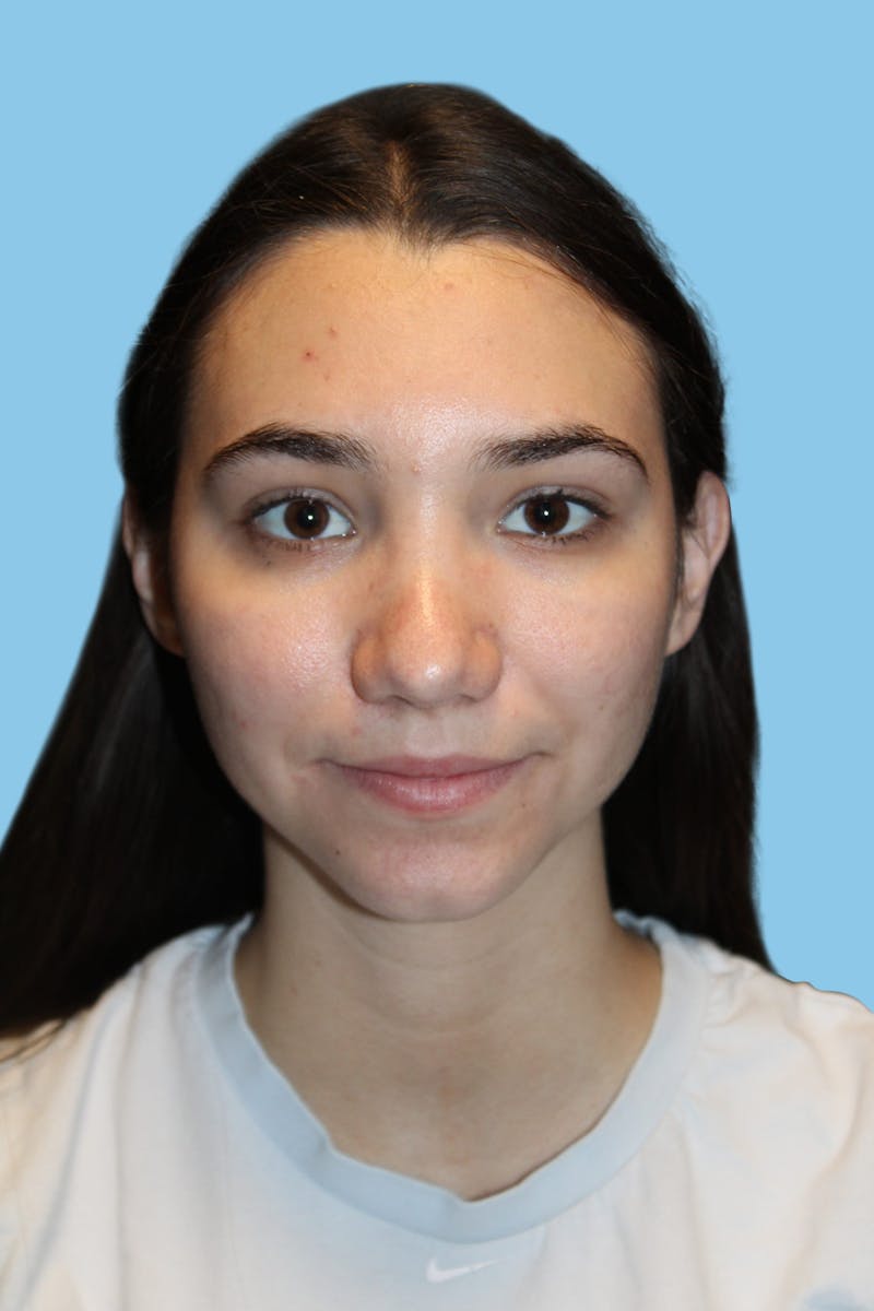 Rhinoplasty Before & After Gallery - Patient 252258 - Image 2