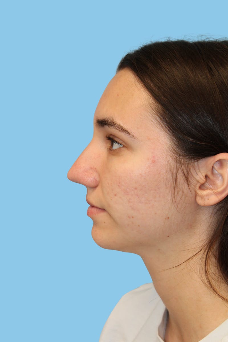 Rhinoplasty Before & After Gallery - Patient 252258 - Image 3