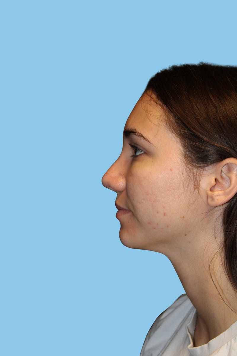 Rhinoplasty Before & After Gallery - Patient 252258 - Image 4