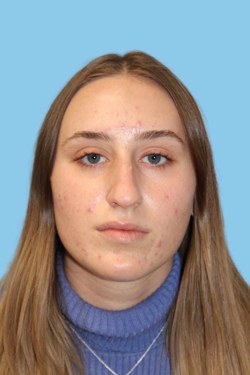 Rhinoplasty Before & After Gallery - Patient 250036 - Image 1
