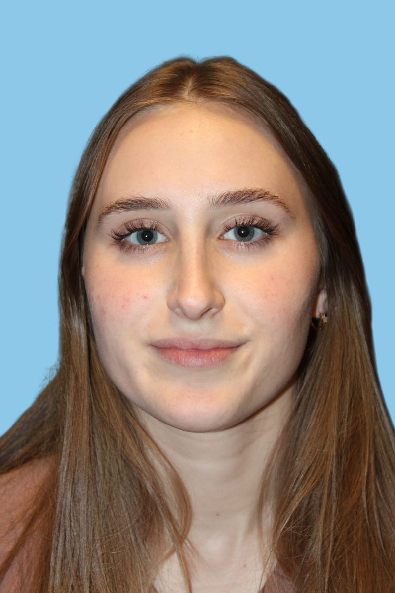 Rhinoplasty Before & After Gallery - Patient 250036 - Image 2