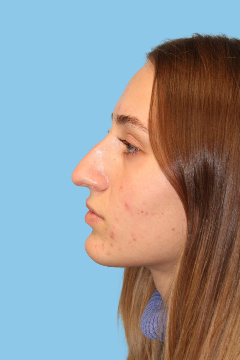 Rhinoplasty Before & After Gallery - Patient 250036 - Image 3
