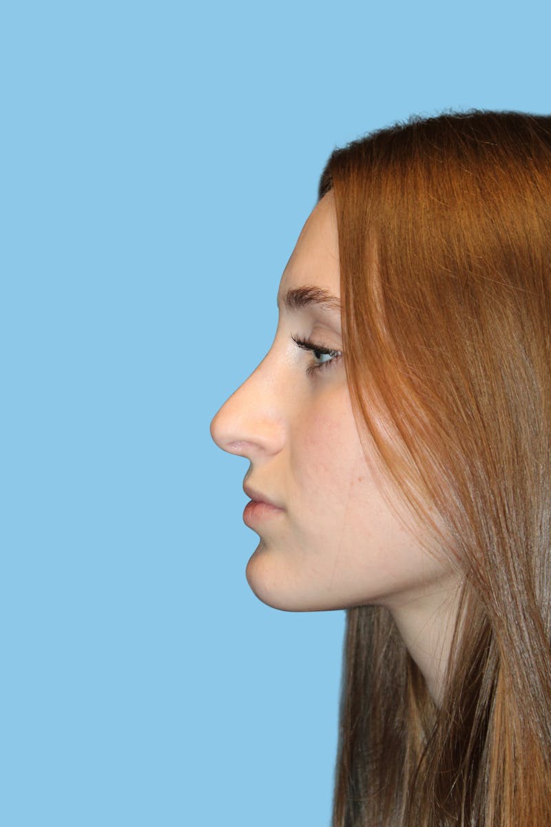 Rhinoplasty Before & After Gallery - Patient 250036 - Image 4