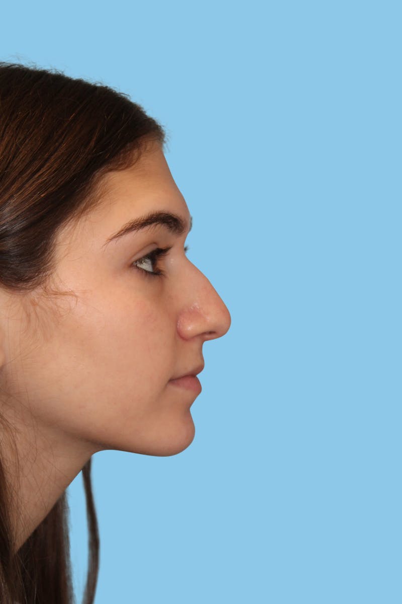 Rhinoplasty Before & After Gallery - Patient 164187 - Image 3