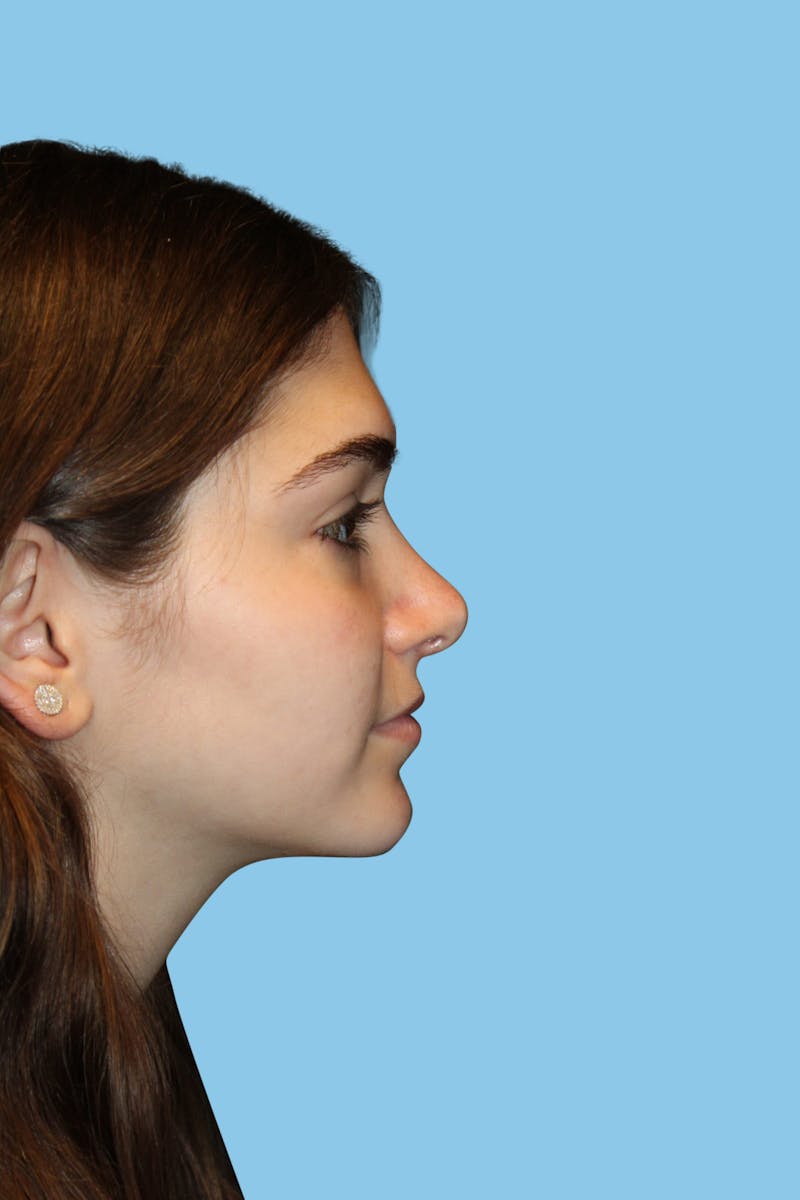 Rhinoplasty Before & After Gallery - Patient 164187 - Image 4