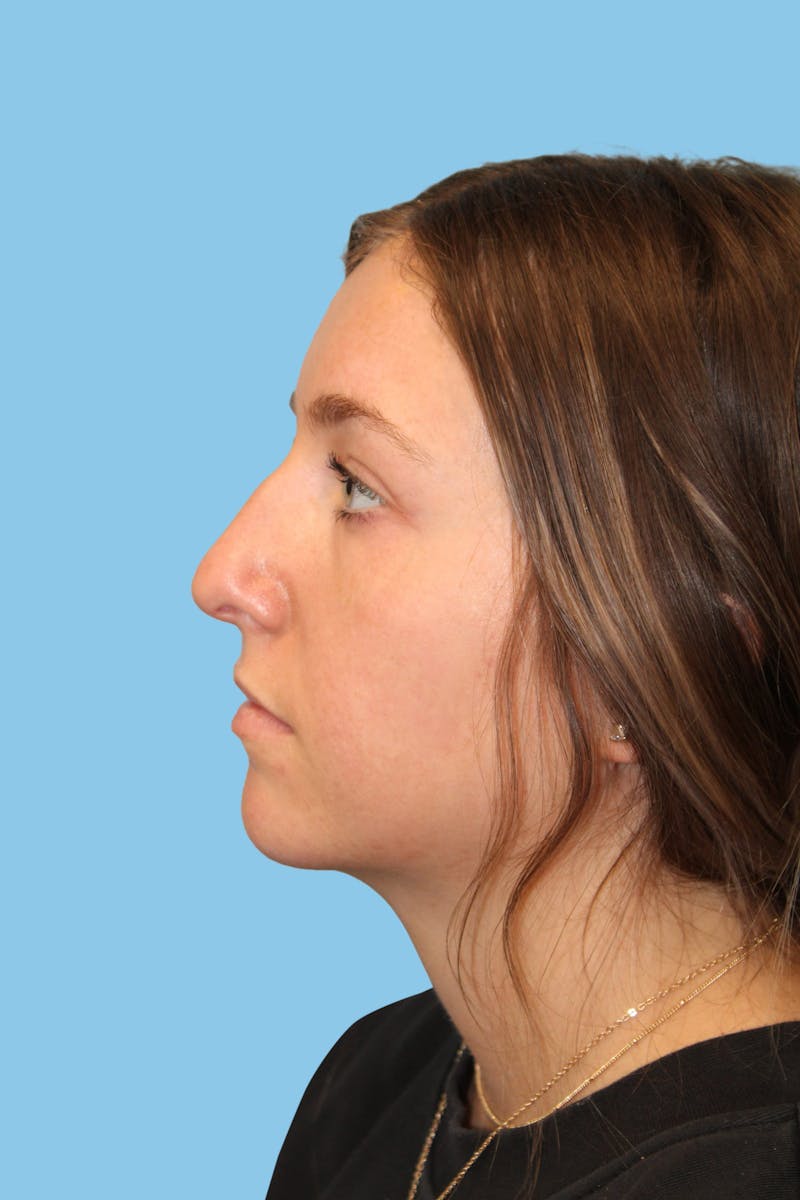 Rhinoplasty Before & After Gallery - Patient 445894 - Image 3