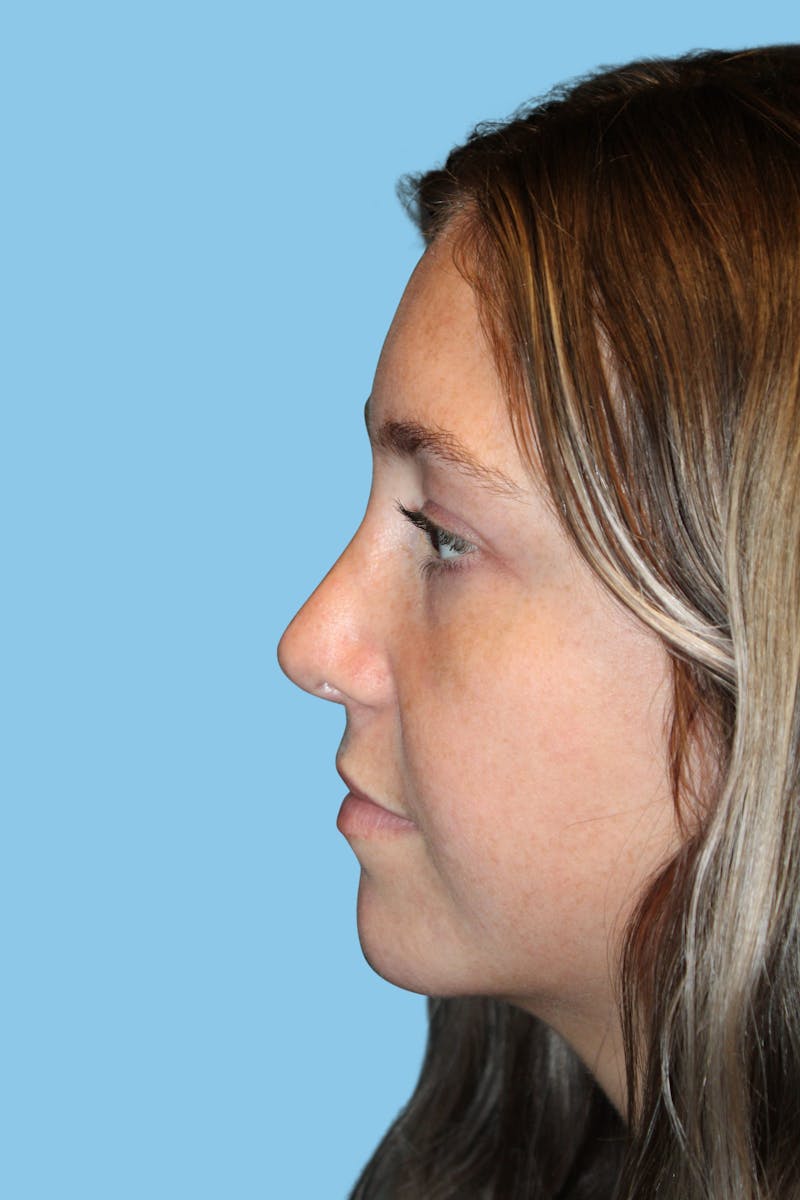Rhinoplasty Before & After Gallery - Patient 445894 - Image 4