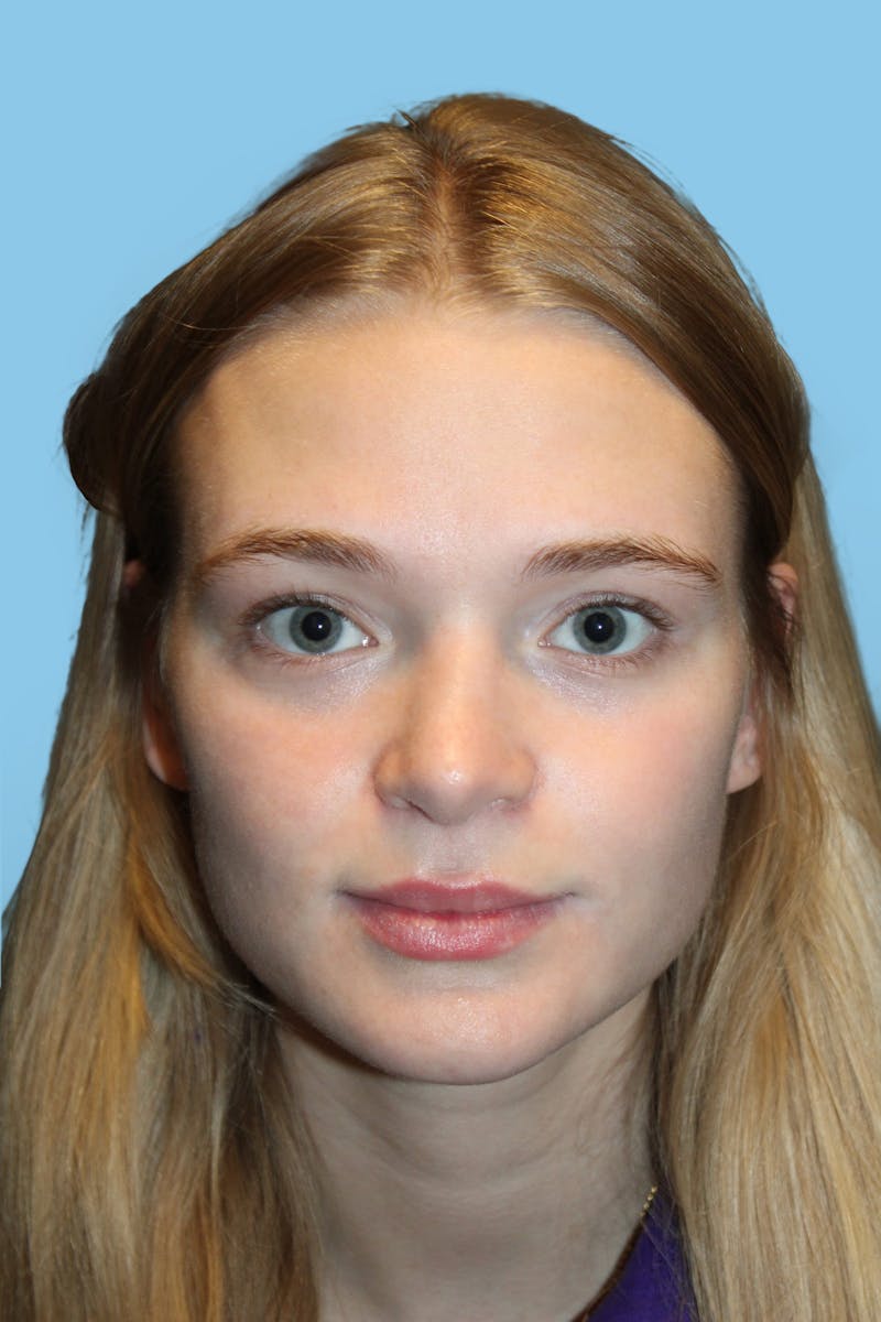 Rhinoplasty Before & After Gallery - Patient 108915 - Image 2