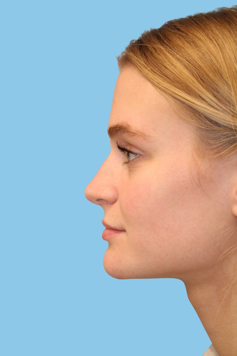 Rhinoplasty Before & After Gallery - Patient 108915 - Image 3