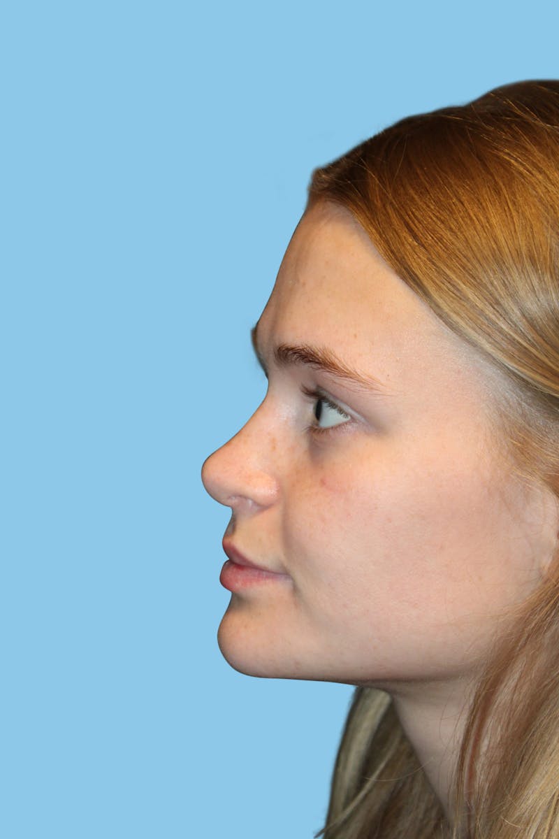 Rhinoplasty Before & After Gallery - Patient 108915 - Image 4