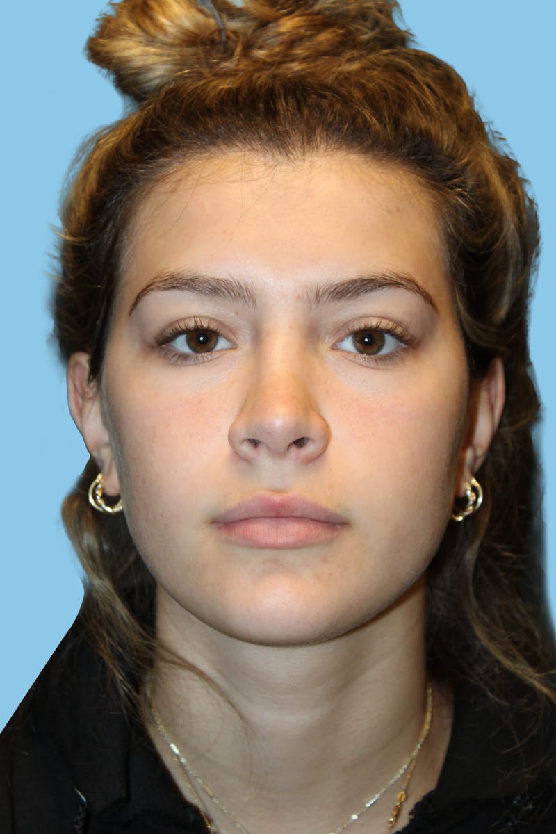 Rhinoplasty Before & After Gallery - Patient 342093 - Image 2