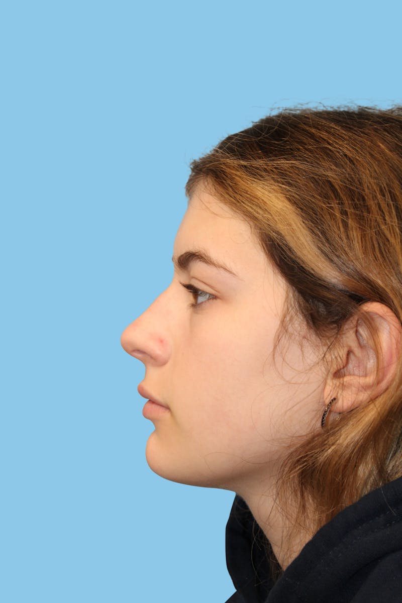 Rhinoplasty Before & After Gallery - Patient 342093 - Image 3
