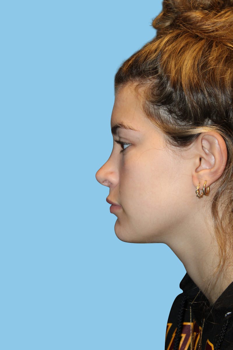 Rhinoplasty Before & After Gallery - Patient 342093 - Image 4