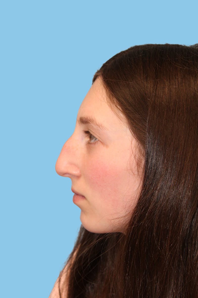 Rhinoplasty Before & After Gallery - Patient 257040 - Image 3