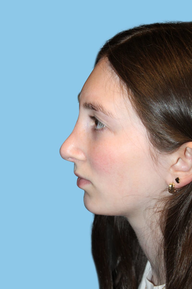 Rhinoplasty Before & After Gallery - Patient 257040 - Image 4
