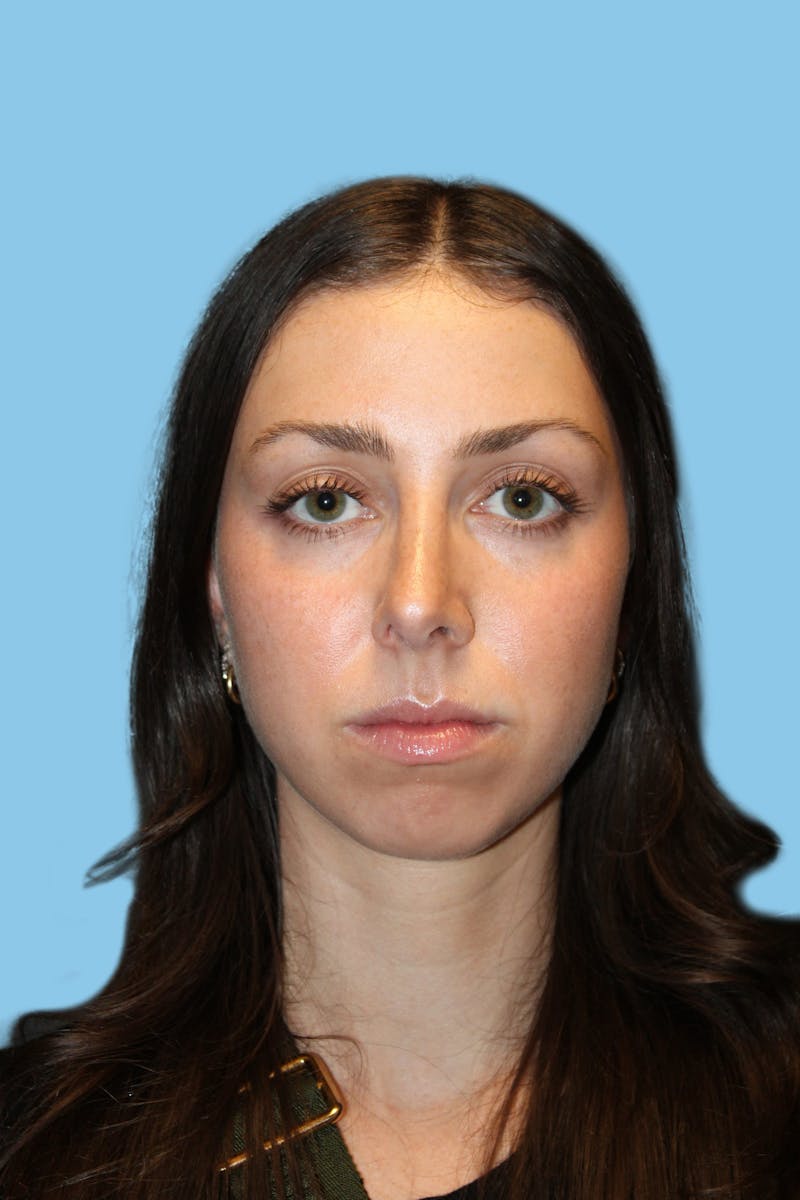 Rhinoplasty Before & After Gallery - Patient 238716 - Image 2
