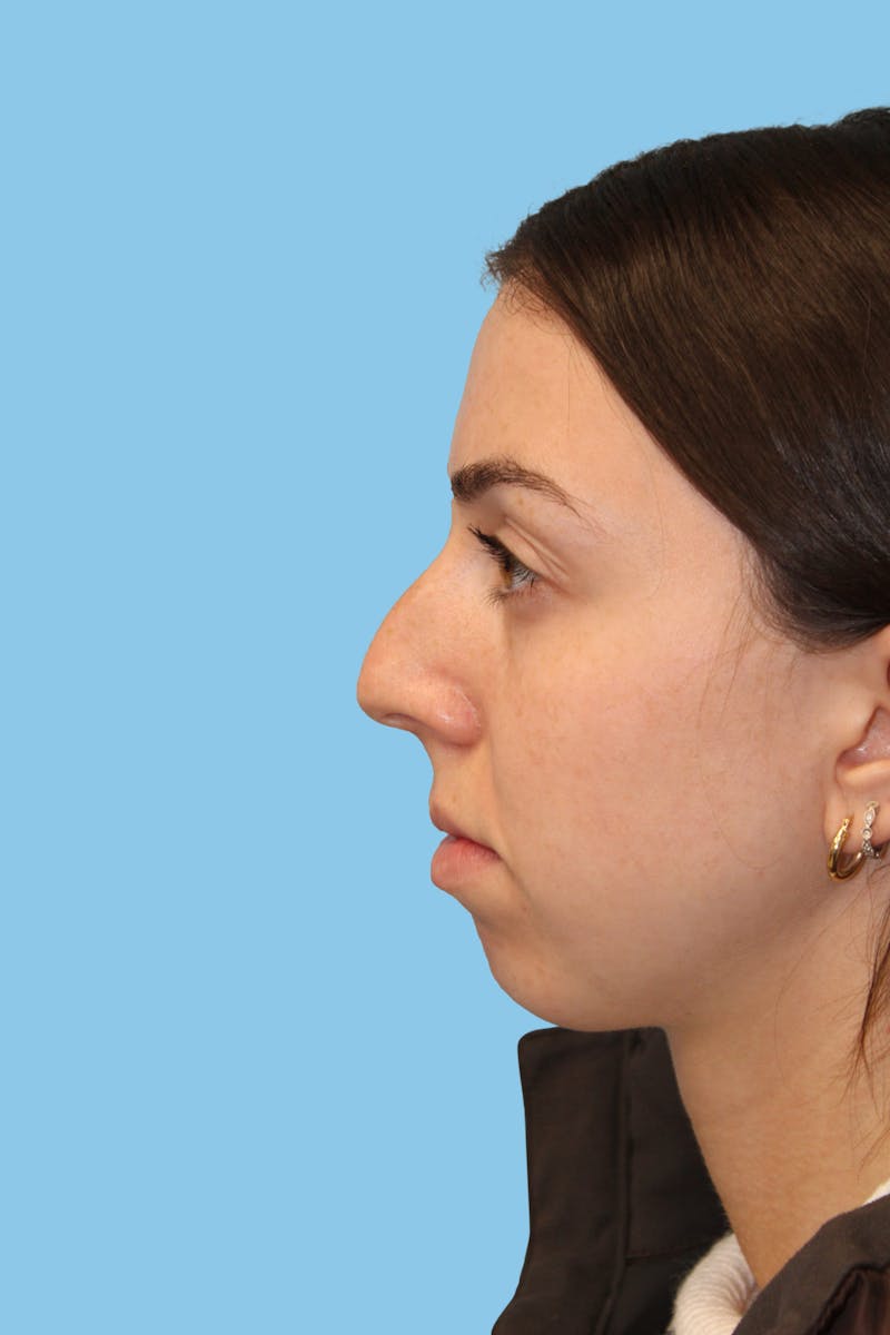 Rhinoplasty Before & After Gallery - Patient 238716 - Image 3