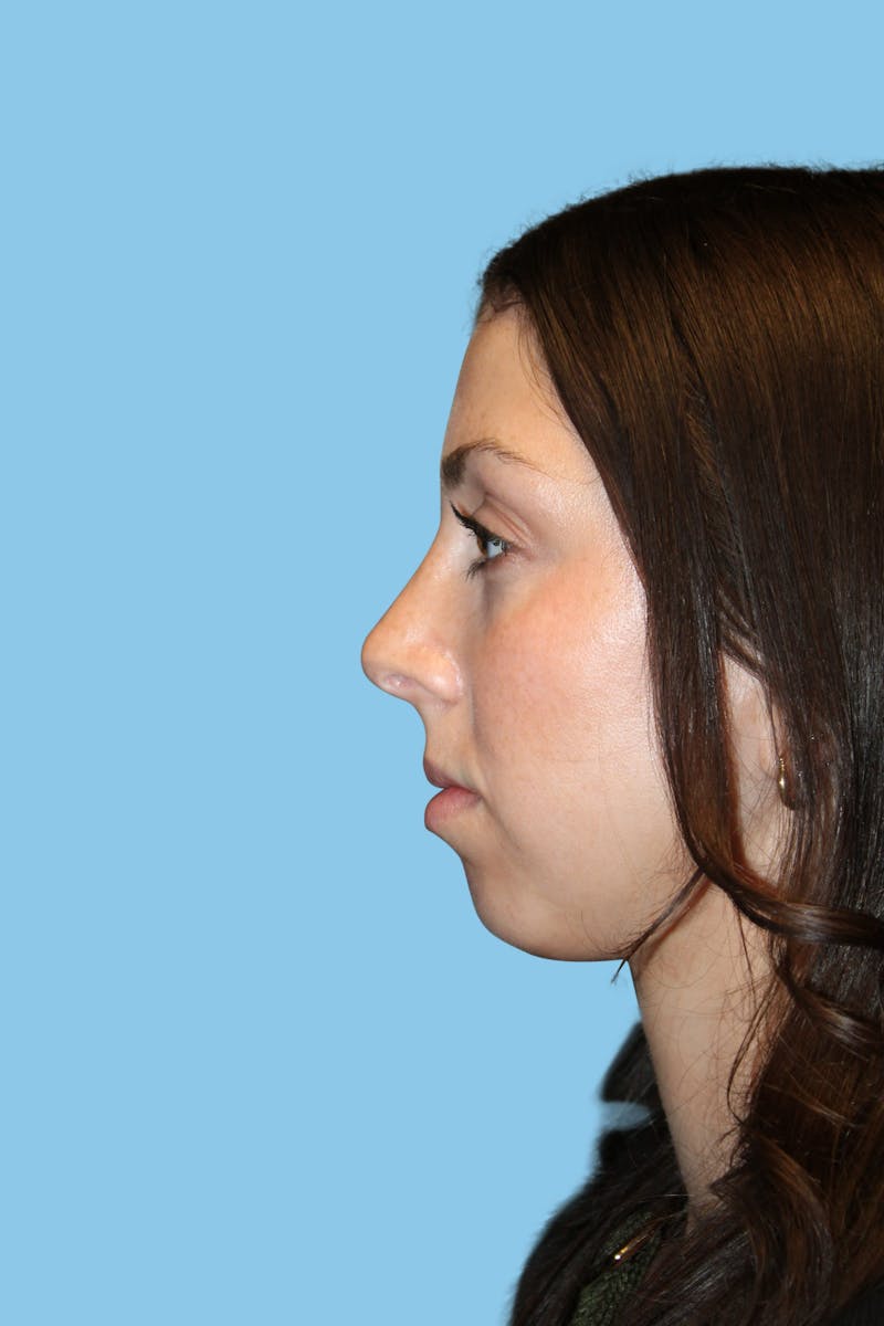 Rhinoplasty Before & After Gallery - Patient 238716 - Image 4