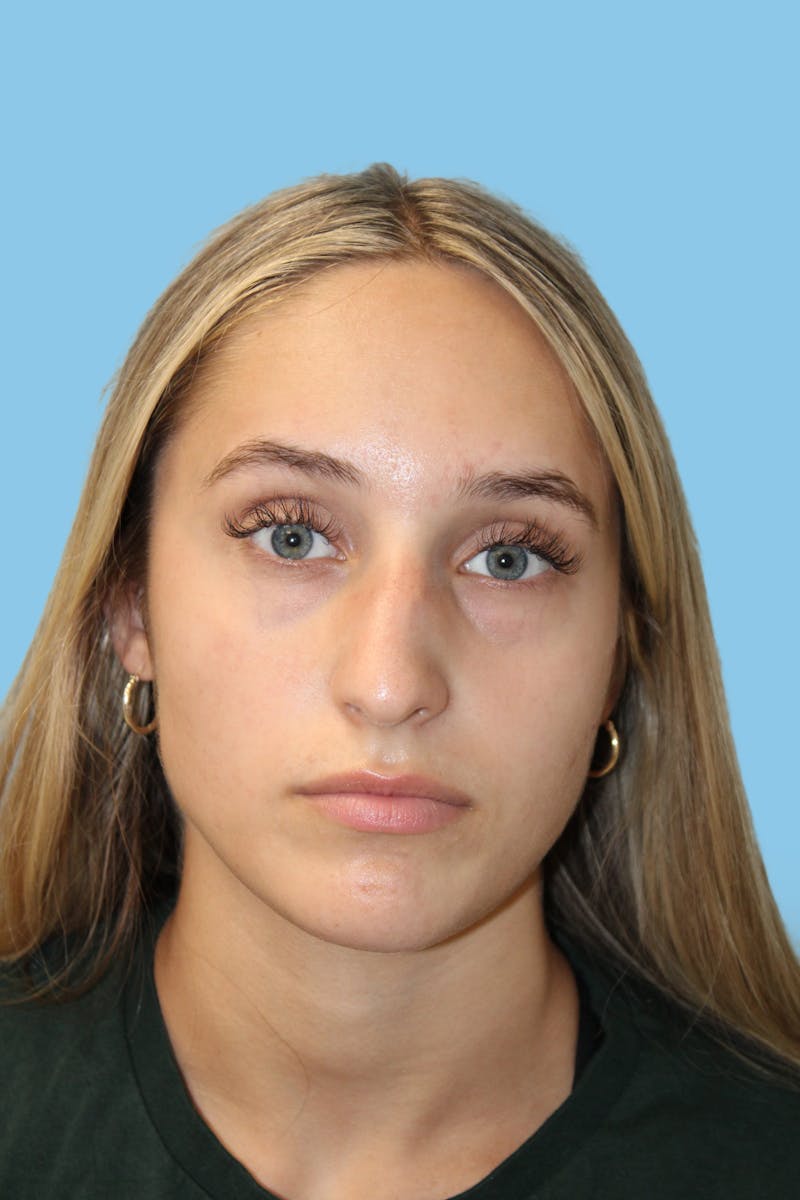 Rhinoplasty Before & After Gallery - Patient 454280 - Image 1