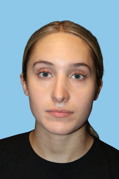 Rhinoplasty Before & After Gallery - Patient 454280 - Image 2