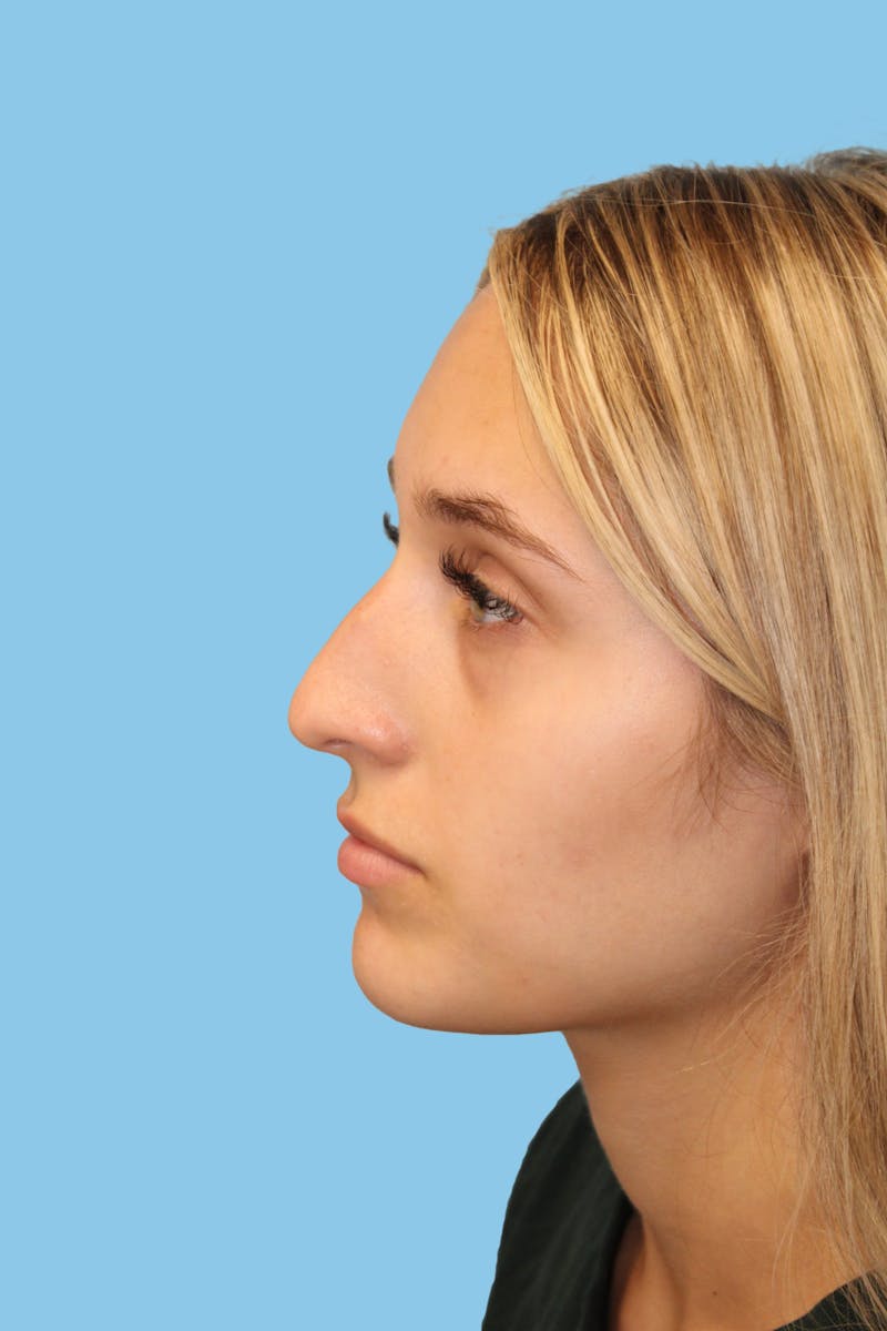 Rhinoplasty Before & After Gallery - Patient 454280 - Image 3