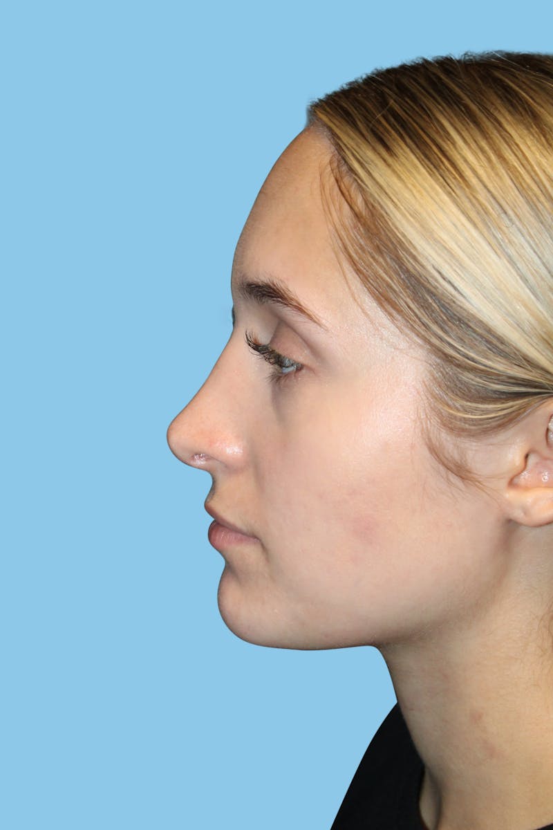 Rhinoplasty Before & After Gallery - Patient 454280 - Image 4
