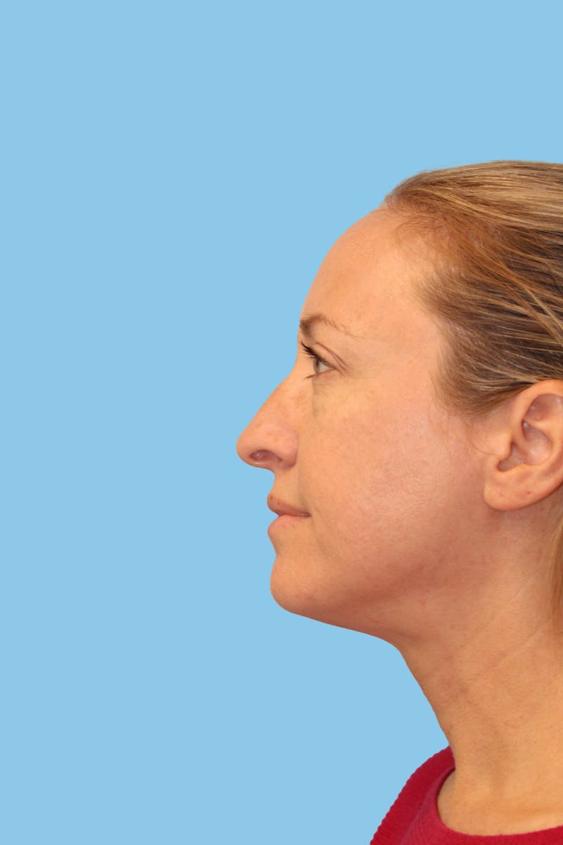 Rhinoplasty Before & After Gallery - Patient 418319 - Image 3