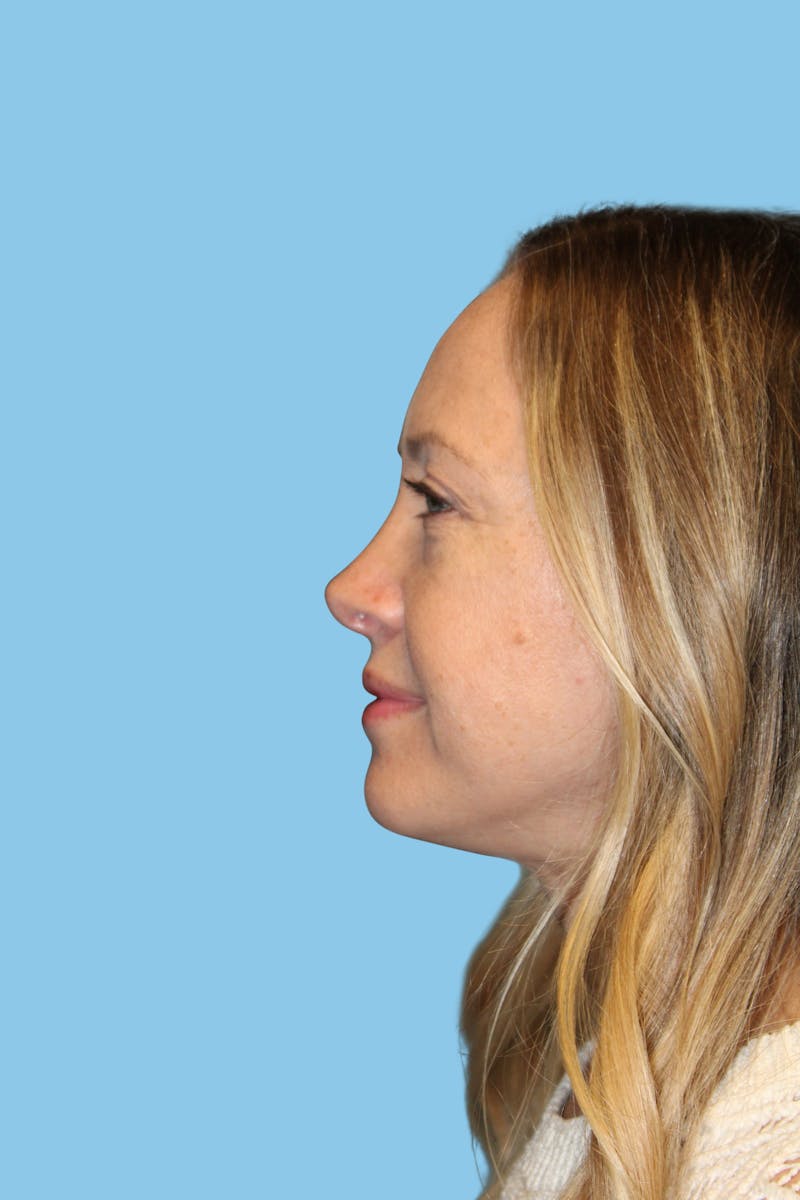 Rhinoplasty Before & After Gallery - Patient 418319 - Image 4