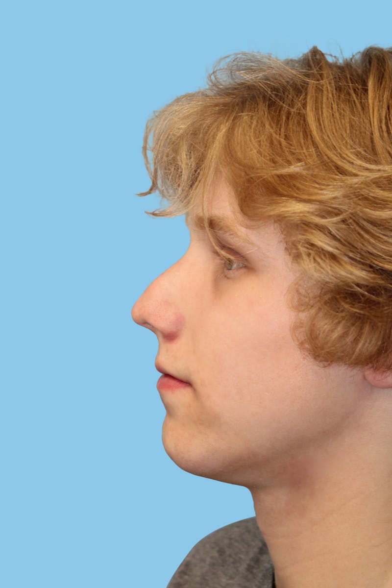 Rhinoplasty Before & After Gallery - Patient 117785 - Image 3