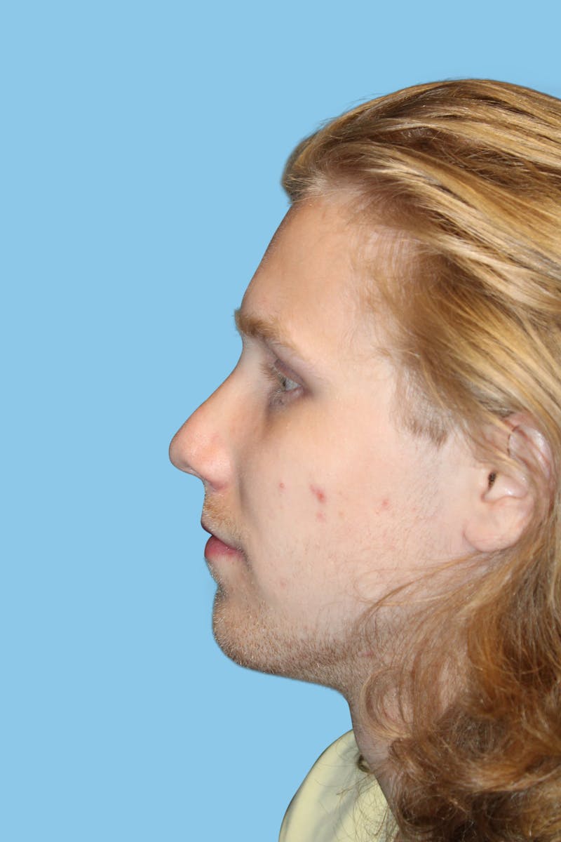 Rhinoplasty Before & After Gallery - Patient 117785 - Image 4