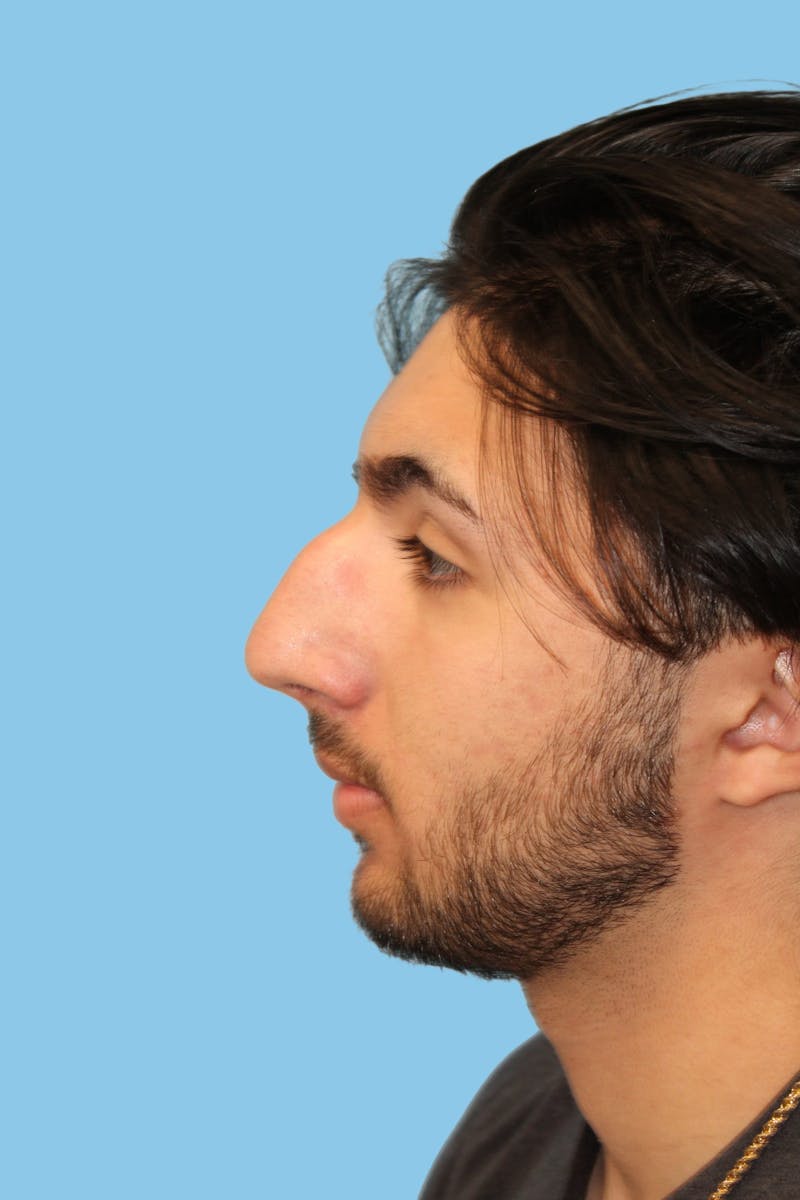 Rhinoplasty Before & After Gallery - Patient 423709 - Image 3