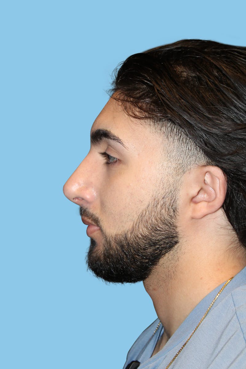 Rhinoplasty Before & After Gallery - Patient 423709 - Image 4