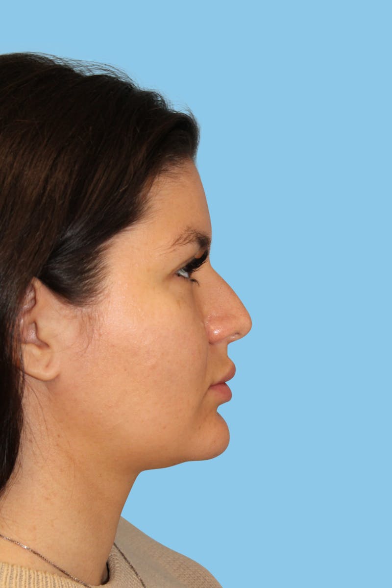 Rhinoplasty Before & After Gallery - Patient 367236 - Image 3