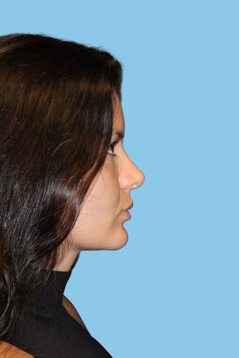 Rhinoplasty Before & After Gallery - Patient 367236 - Image 4