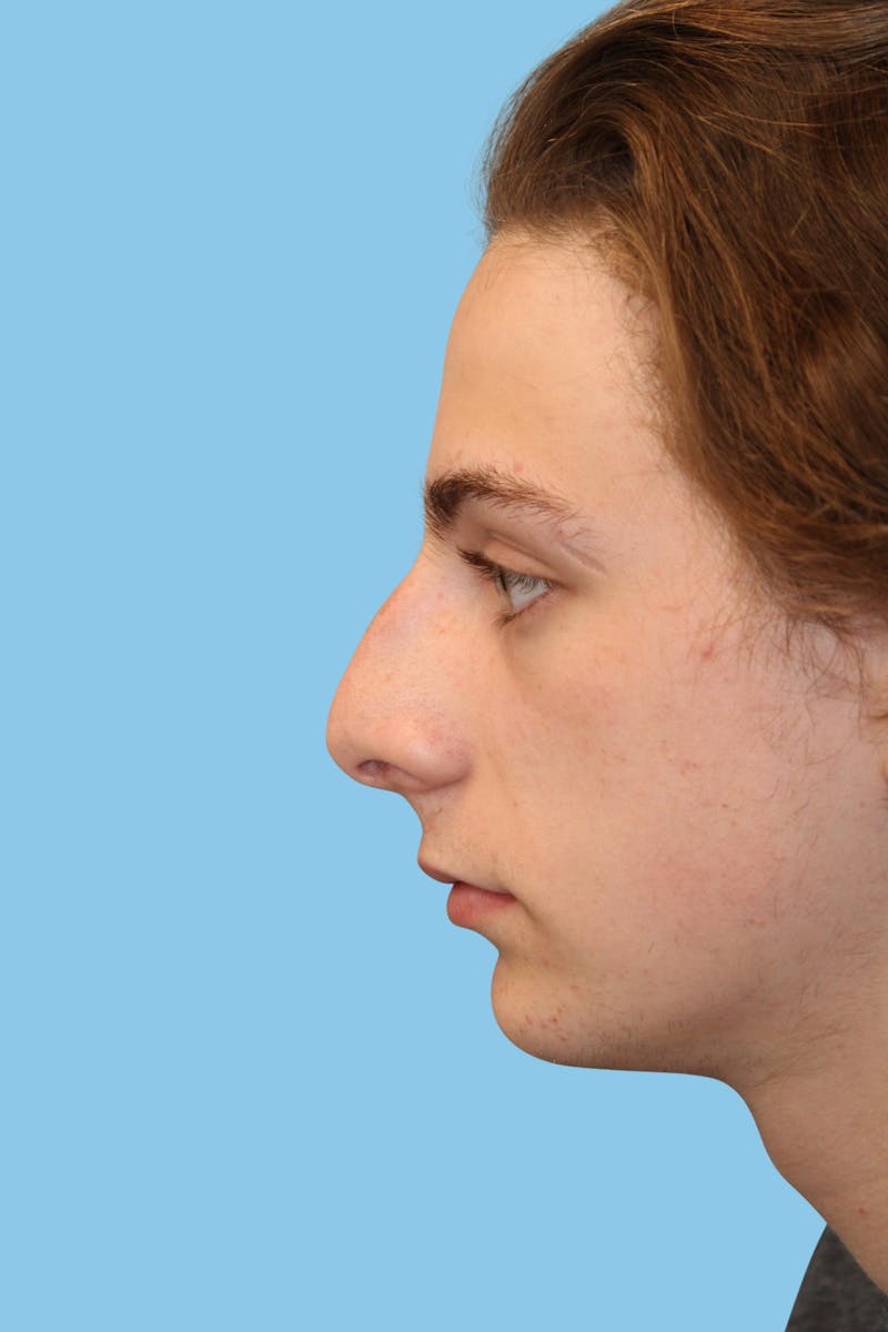 Rhinoplasty Before & After Gallery - Patient 302780 - Image 3