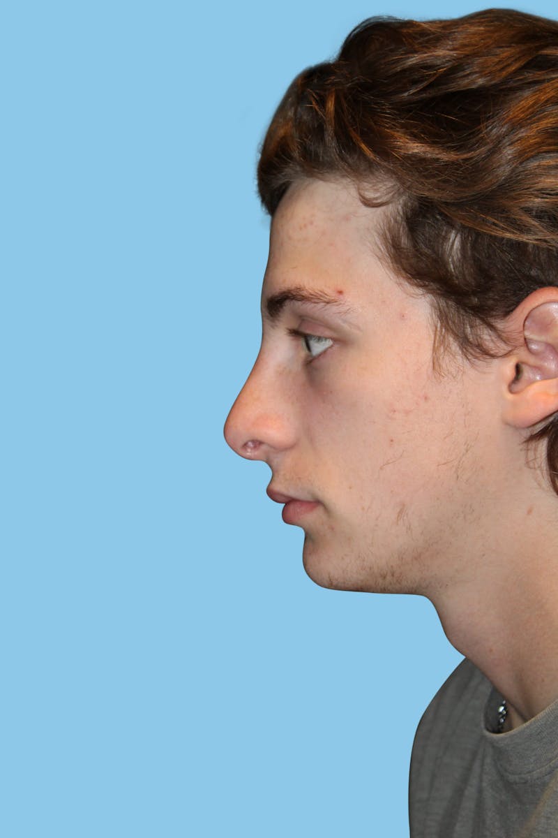 Rhinoplasty Before & After Gallery - Patient 302780 - Image 4