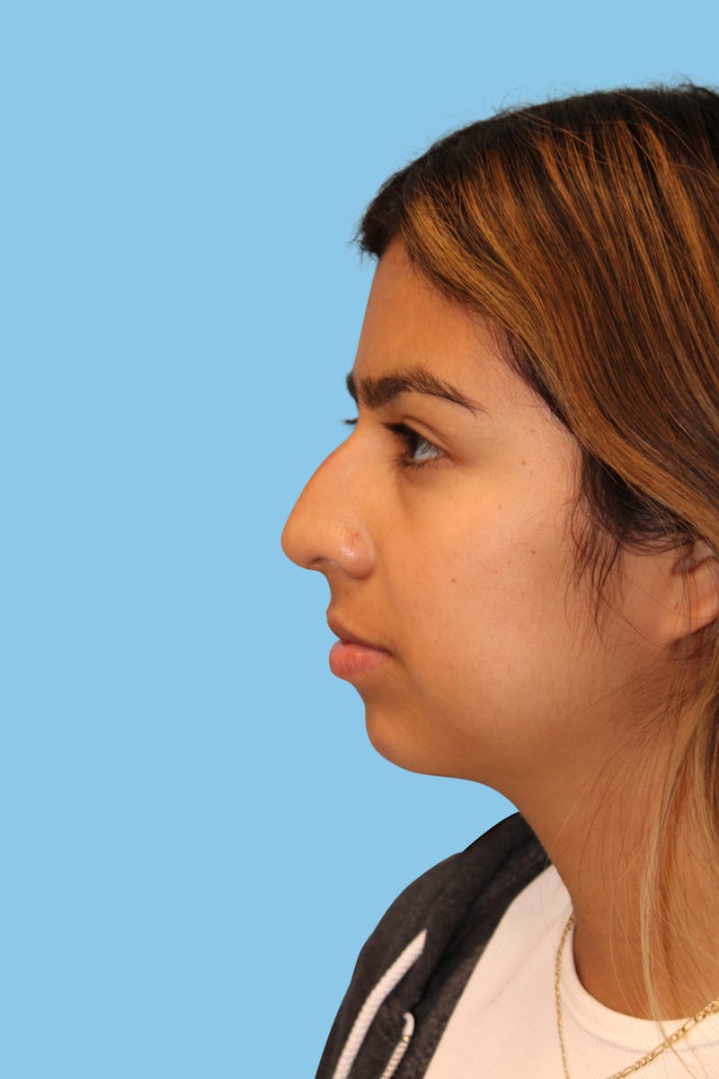 Rhinoplasty Before & After Gallery - Patient 351222 - Image 3