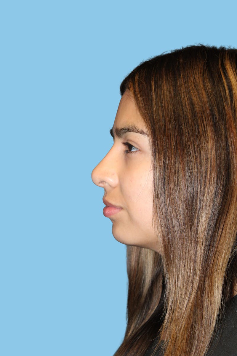 Rhinoplasty Before & After Gallery - Patient 351222 - Image 4