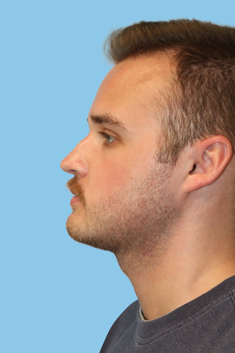 Rhinoplasty Before & After Gallery - Patient 152184 - Image 3