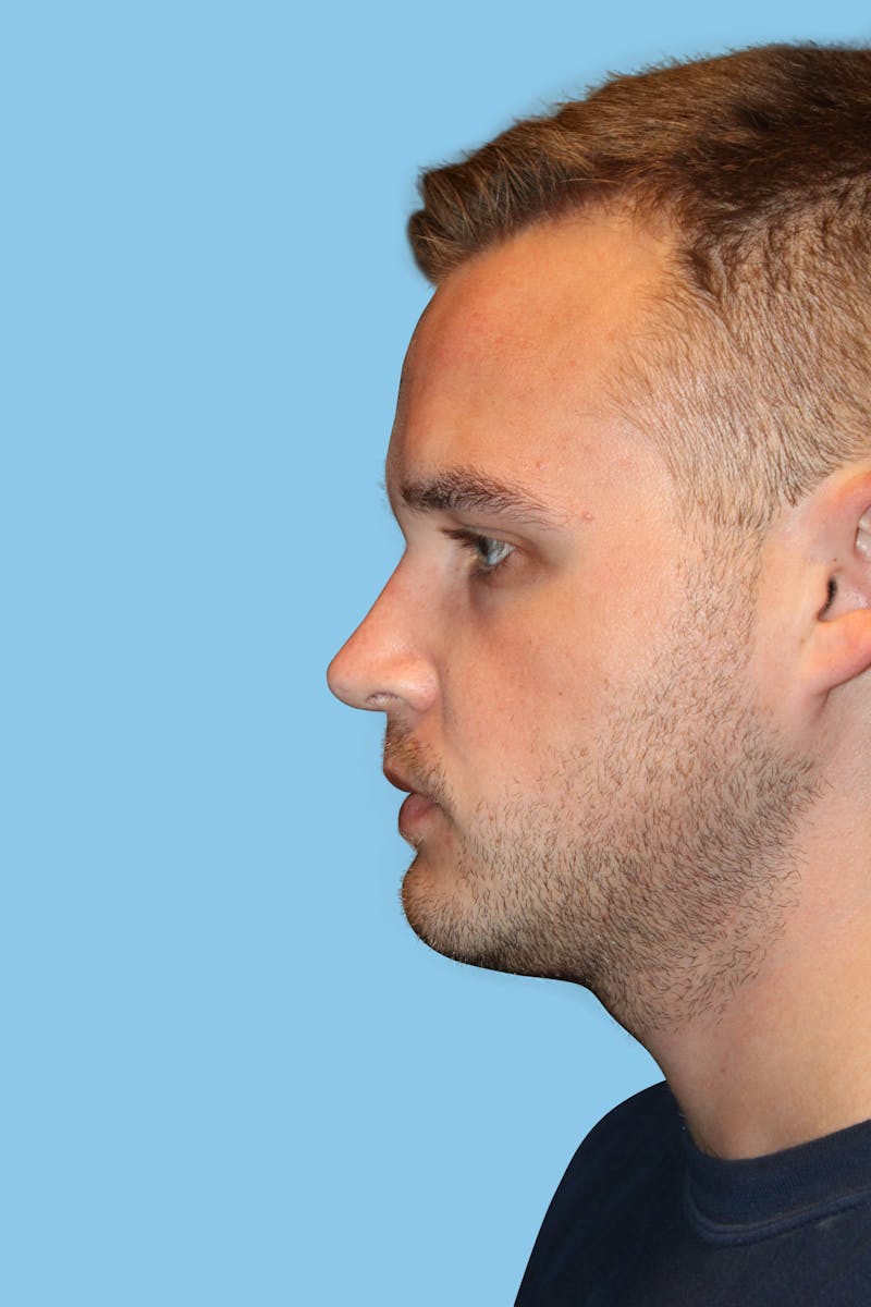 Rhinoplasty Before & After Gallery - Patient 152184 - Image 4