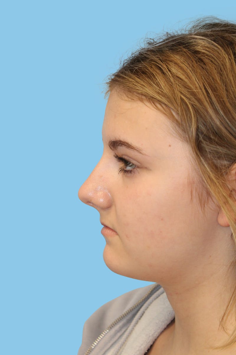 Rhinoplasty Before & After Gallery - Patient 267955 - Image 3