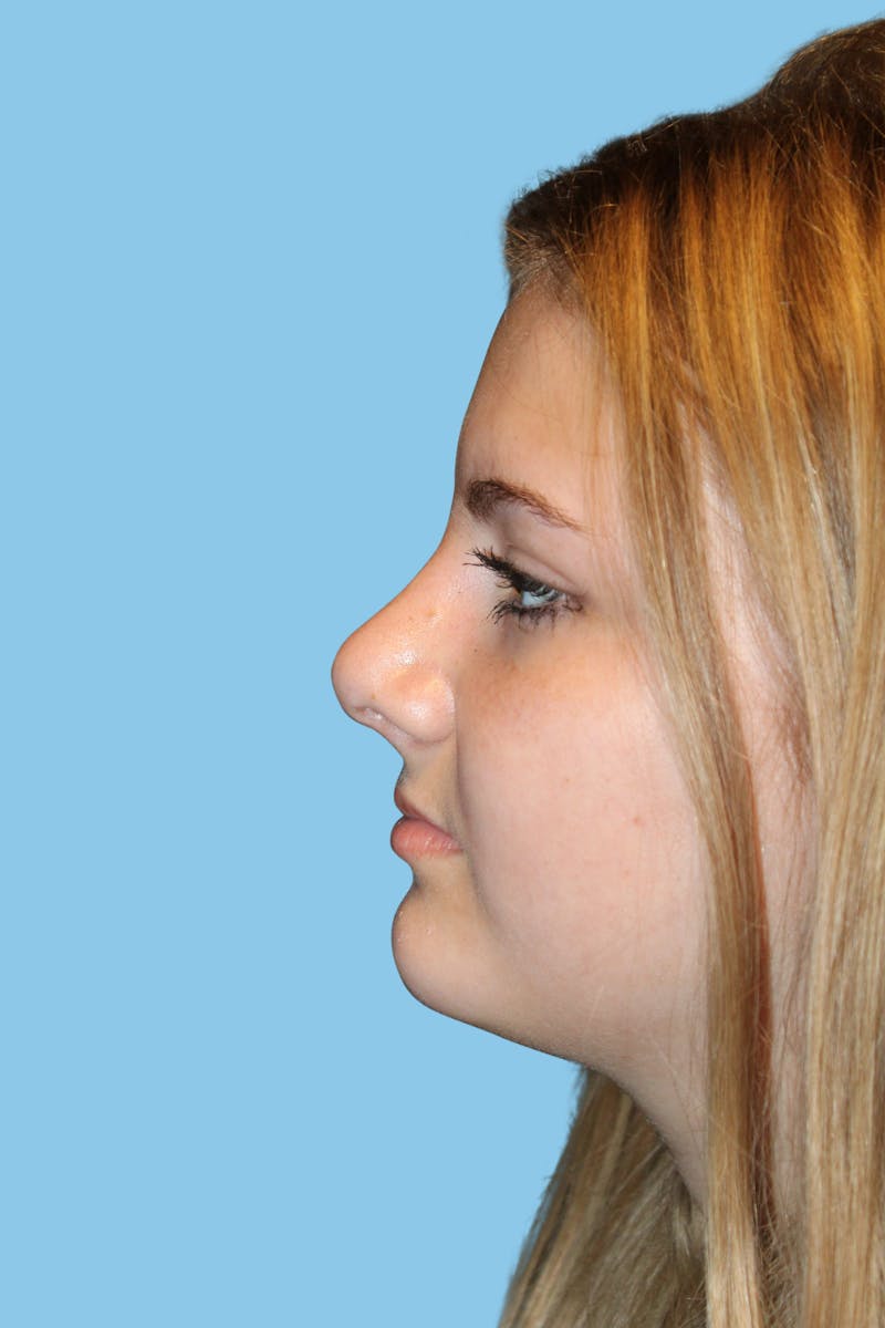 Rhinoplasty Before & After Gallery - Patient 267955 - Image 4
