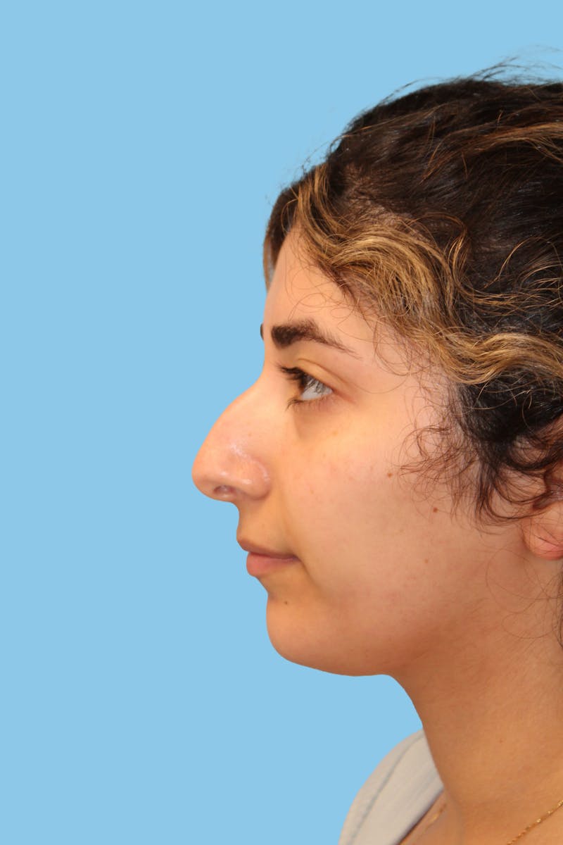 Rhinoplasty Before & After Gallery - Patient 199676 - Image 3
