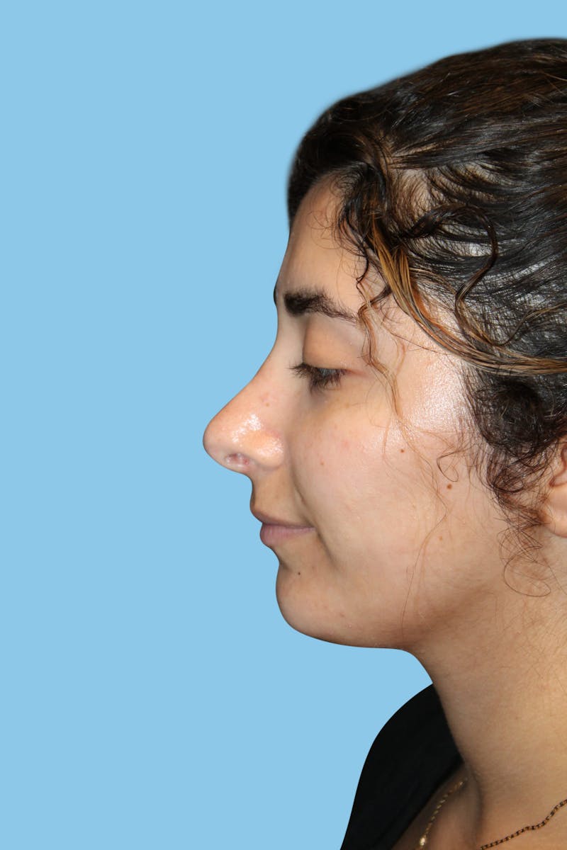 Rhinoplasty Before & After Gallery - Patient 199676 - Image 4