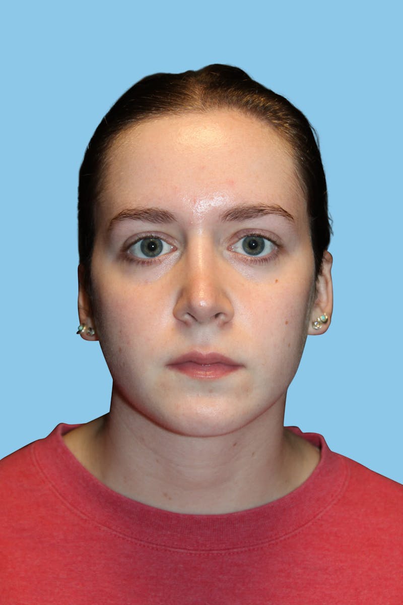 Rhinoplasty Before & After Gallery - Patient 220956 - Image 2