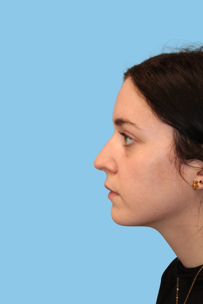 Rhinoplasty Before & After Gallery - Patient 220956 - Image 3
