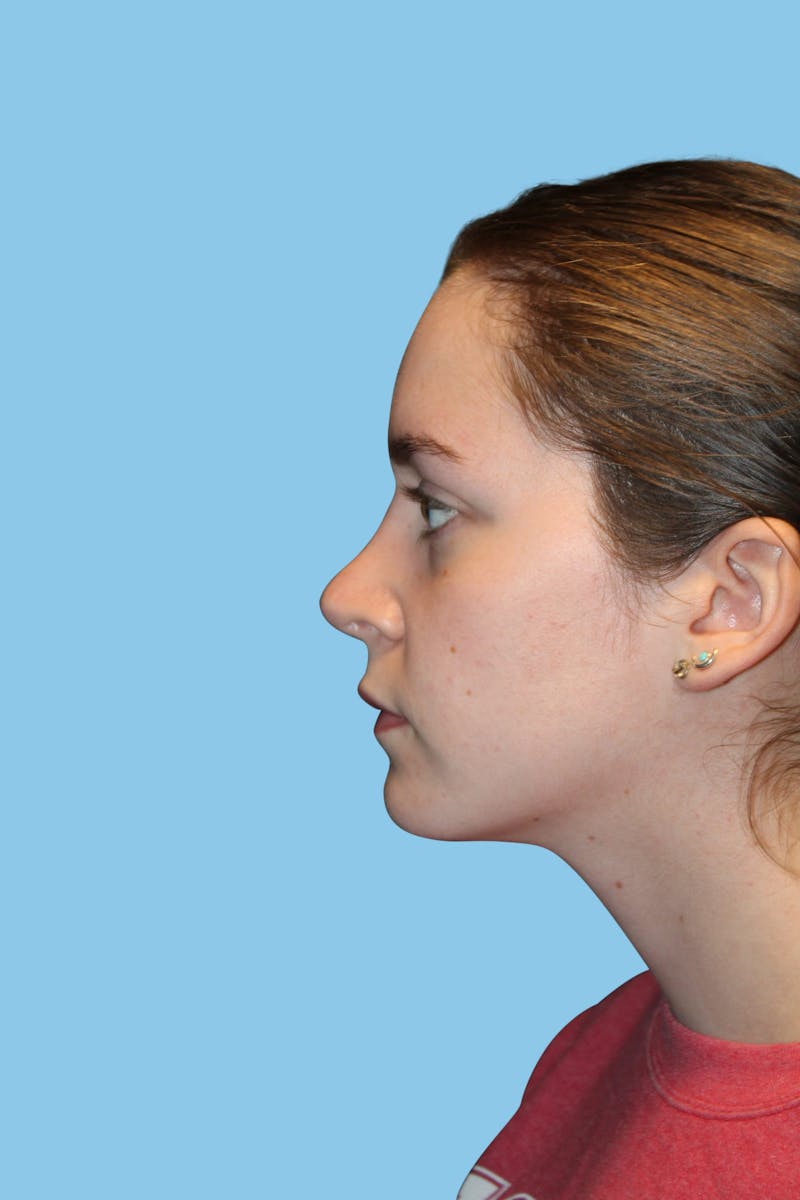 Rhinoplasty Before & After Gallery - Patient 220956 - Image 4