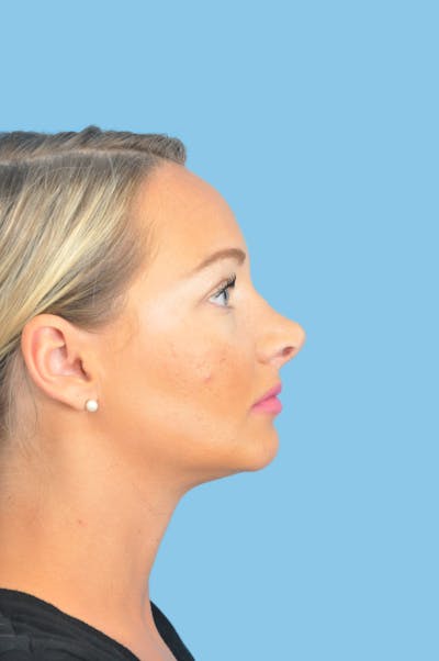 Revision Rhinoplasty Before & After Gallery - Patient 138078 - Image 1